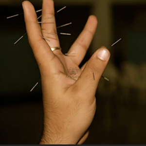 AcuSathi™ Sujok Needle Inserter Tool - Premium - Image 3